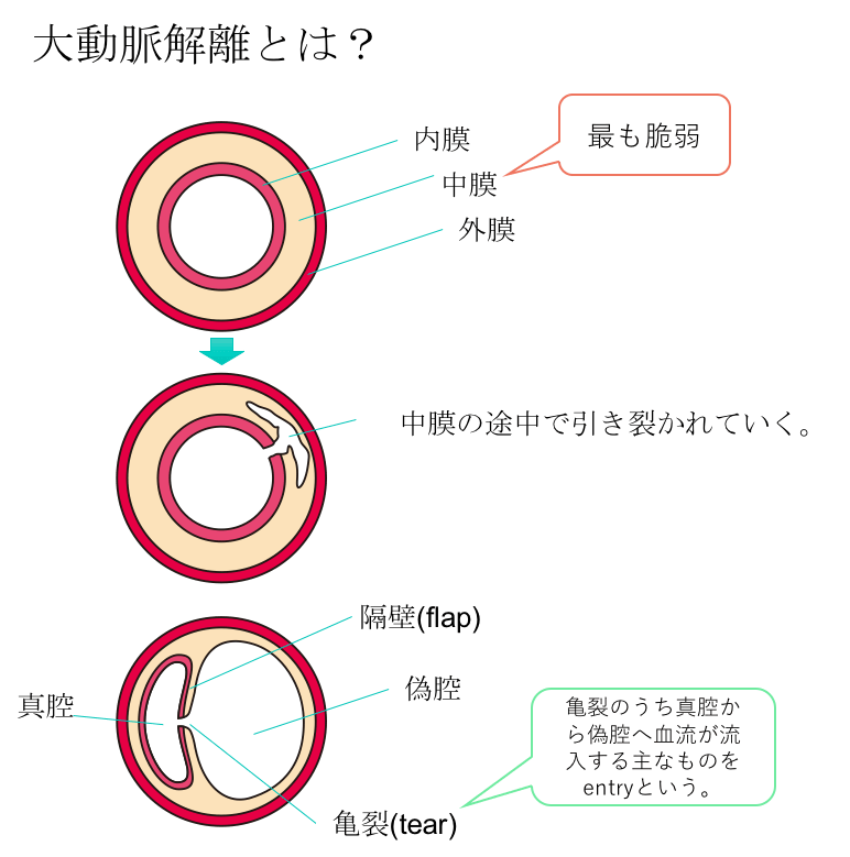 大動脈解離: 病理・診断・治療 | 大動脈解離 - 中外医学社 保存版大動脈解離まとめ!症状・治療・CT画像所見のポイントは? 小樽市立病院 大動脈解離: 病理・診断・治療 | 大動脈解離 - 中外医学社 保存版大動脈解離まとめ!症状・治療・CT画像所見のポイントは? 小樽市立病院